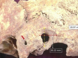 Археологи обнаружили останки людей IV - VII веков с необычными хирургическими вмешательствами