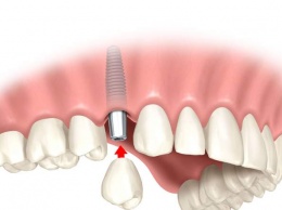 Преимущества имплантации зубов: что это, зачем и кому нужно