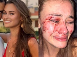 Избиение украинской топ-модели в Турции: девушку обвинили в клевете