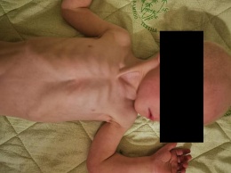 В крымском Минздраве прокомментировали информацию об истощенном ребенке из детдома