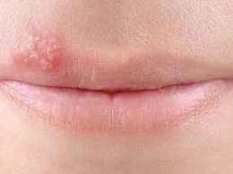 Герпес на губе: как быстро и натуральными способами избавиться от болячки