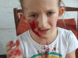 Лицо в крови: в Днепре собака напала на девочку