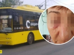 В Сумах пассажир изувечила кондуктора из-за маски: фото и детали ЧП