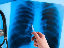 В Украине за год туберкулез диагностируют у почти тысячи детей - эксперты