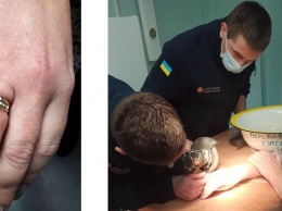 Спасатели помогли женщине снять кольцо с пальца