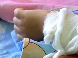 Нужна помощь: в запорожскую больницу попала малышка с 12% ожогами лица (фото 18+)