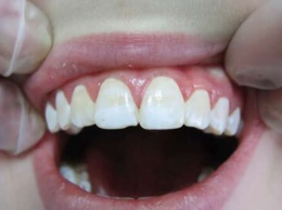 Как избавиться от желтого налета на зубах?