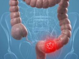 Онкологи назвали необычный признак рака кишечника