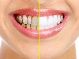 Без похода к стоматологу: как самостоятельно удалить зубной налет