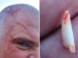 Акула сломала зуб об голову мужчины, пытаясь укусить его