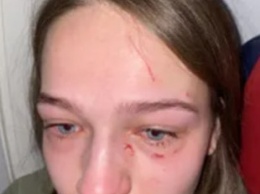 Украинке в самолете расцарапали лицо и отгрызли ноготь: блогер рассказал детали