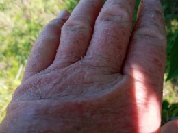 Руки покраснели, кожа слезла: на сборе черешни женщина заработала химический ожог