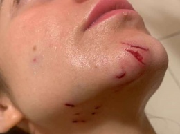 Вцепилась в шею: хаски напала на девушку в Днепре возле Каравана (ФОТО)