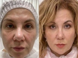 Марина Федункив без операции уменьшила нос и подкорректировала овал лица