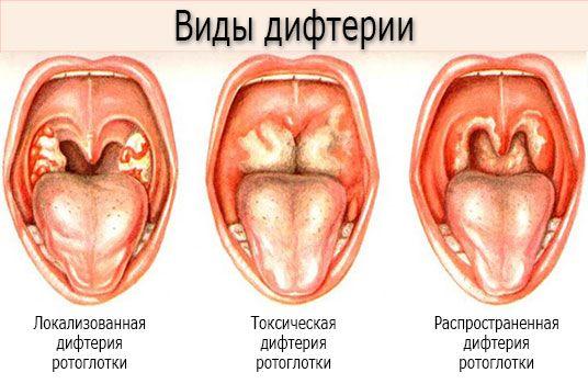 Вспышка дифтерии в Украине: что это за болезнь, как передается, симптомы