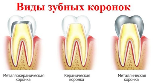 Какие коронки лучше ставить на передние и жевательные зубы?