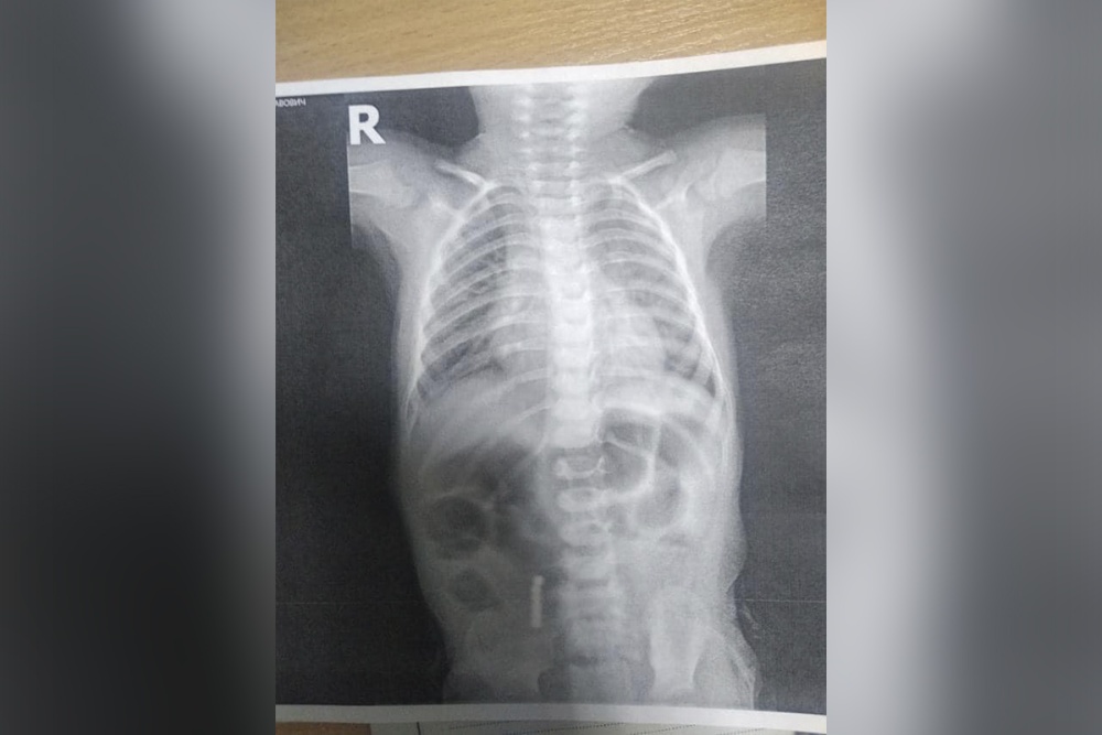 Детали продырявили кишечник: в Днепре прооперировали 2-летнего мальчика, который проглотил головоломку