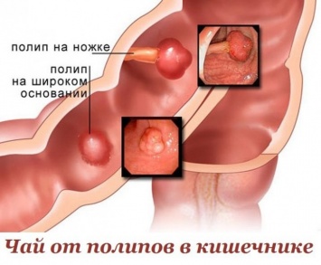 Чай от полипов в кишечнике!