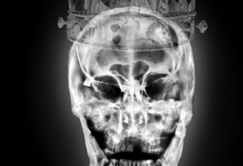 Рентгеновские снимки короля Англии стали арт-объектом