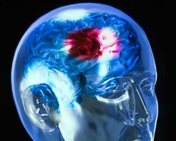 Ученые выяснили, что помогает мозгу восстановиться после инсульта