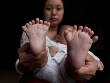 Родители мальчика с 31 пальцем из Китая пытаются собрать деньги на операцию (фото)