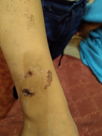 В поликлинике Днепра ребенка били током и выжигали кожу