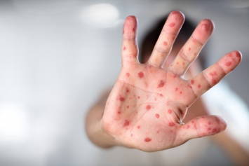 Опасная инфекция атакует украинцев: прививки не помогают