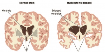 Раскрыта новая деталь процесса гибели нейронов в головном мозге