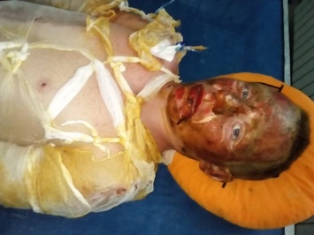 Страдающему подростку в Харькове сняли отмершую кожу