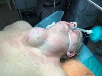 Высший пилотаж: в больнице Мечникова пациенту удалили гигантскую опухоль на шее