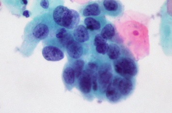 Ученые заставили организм "пожирать" раковые клетки