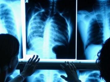 На Полтавщине у работницы детского сада выявлена открытая форма туберкулеза