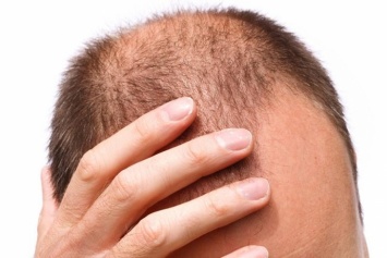 Названы главные причины выпадения волос