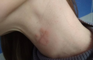 Странную инфекцию обнаружили у подростка из Харьковской области