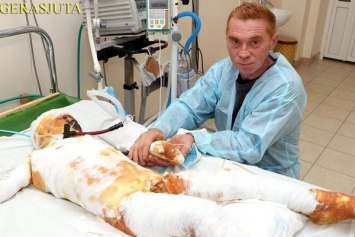 На Николаевщине родители бросили в больнице обожженого сына, который чудом выжил после удара током
