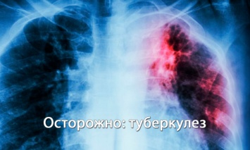 Что такое туберкулез и как его избежать: причины, симптомы, профилактика