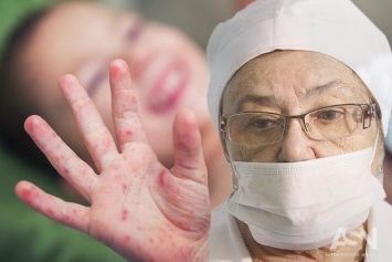 В Донецкой области очередная вспышка кори? Более 20-ти человек попали в больницу