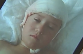 Миллион компенсации присудили семье девочки, которая проломила болтом голову в детсаду
