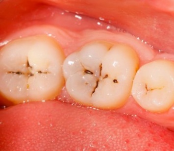 Последствия зубного кариеса и его лечение