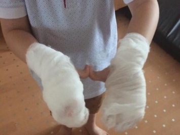 В Николаеве ребенок получил ожоги обеих рук жидким азотом в познавательном конкурсе. Фото