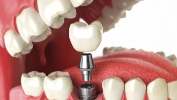 Зубные протезы или импланты?