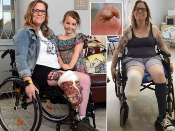 Девушке с диабетом отрезали ногу из-за вросшего ногтя