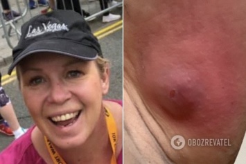 Дыра в руке: в Британии женщина попала в больницу после укуса паука