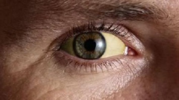 О чем сигнализируют желтые белки глаз