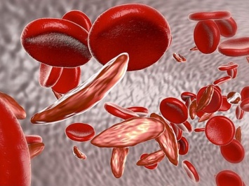 Редактура ДНК поможет при серповидноклеточной анемии