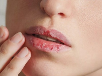 Сухие губы могут указывать на развитие разных заболеваний в организме