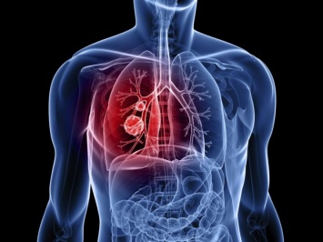 Нанотехнологии показали выдающиеся результаты в лечении рака легких