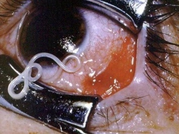 Московские врачи вытащили из глаза мужчины червя длиной 3 см