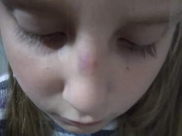 Школьники в Керчи избили новенькую: девочке сломали нос