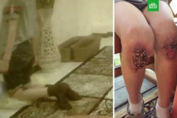 Зверски издевались: в России из-за пыток ребенку вросла в ноги гречка (фото 18+)